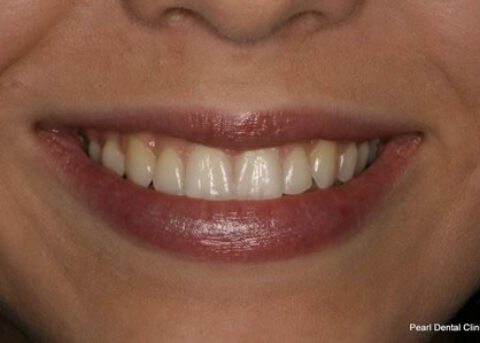 After Image - Invisalign